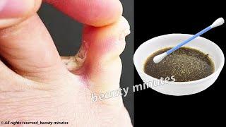 A wonderful home remedy for fungus between the toes forever