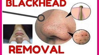 DIY Clear Skin Facial How to remove Blackheads Comedone Extraction Easy get rid unclog pores