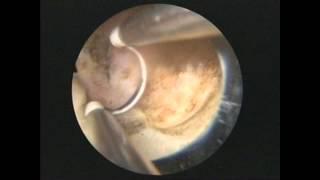 Plasmakinetic TURP and Plasma vaporisation in 100 cc prostate. Dr.Farid Gadimaliyev