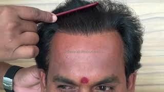 amazing density hair transplant - pioneer clinic