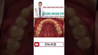 타 치과에서 4년 동안 교정 끝내지 못한 환자 #shorts #쇼츠