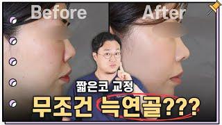 갈비연골(자가늑,기증늑) 없이도 짧은 코와 들창코를 교정하기 위해 확인해야만 하는 것