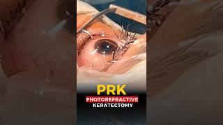Live Photorefractive Keratectomy (PRK) Surgery