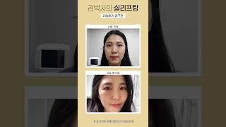 #shorts 팔자주름이 고민있던 망구씨! 실리프팅 전후 대박
