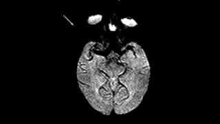 Normal brain perfusion