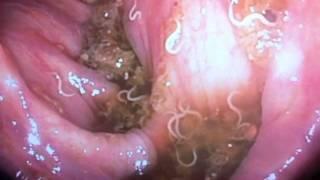 Pinworms found on colonoscopy