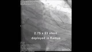 OCT guided Multivessel PCI, with LM-LAD stenting
