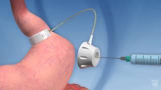 Laparoscopic adjustable gastric banding