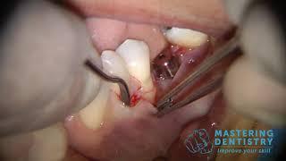 Connective tissue graft in implantology to treat horizontal atrophy MD