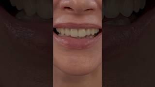 10 Porcelain Veneers #veneers #smilemakeover #dentist