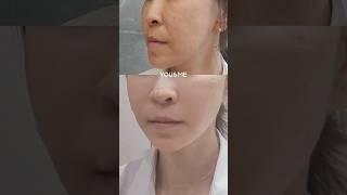 요즘 핫한 중안부축소 방법수술 없이 가능해요!