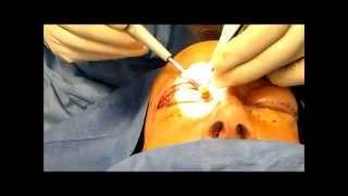 Upper Eyelid Lift inside the Operating Room With Dr. Singh