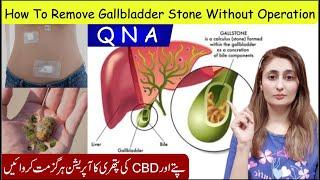 How To Remove Gallbladder Stone Q N A By Zunaira | Gallbladder Stones Treatment Without Operation?