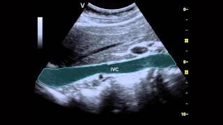 Ultrasound of the IVC