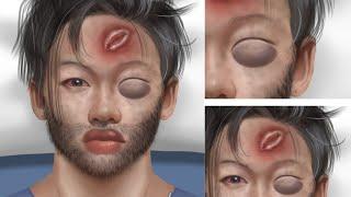 ASMR Treatment acne and seborrheic dermatitis on the face, remove blackheads