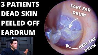 3 Patients With Dead Skin Trapping Eardrum (LIVE AUDIO LAST CASE)