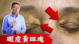 眼皮的黃斑塊 ,膽固醇與膽鹽自然療法 柏格醫生 Dr Berg