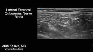 Lateral Femoral Cutaneous Nerve Block