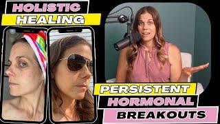 Holistic Health Path to Clear Skin - Adult Hormonal Acne (Personal Story of Holistic Living Success)