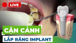 [CẬN CẢNH] Các Bước Chi Tiết Lắp Răng Sứ Implant Phục Hồi Răng Hàm.