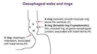 Esophageal Webs / Rings ; Definition, Causes, Symptoms, Diagnosis and Treatment