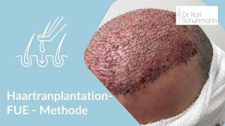 Haartransplantation  Düsseldorf  - FUE Methode für volles und schönes Haar