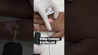 Vitiligo Treatment at DA Dermatology Clinic ! #vitiligo #vitiligoawareness #vitiligocure