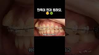 씹을 때 오른쪽이 먼저 닿아요. 불편해요.  #교정중생기는