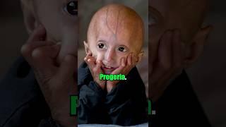 This Disease Makes Kids Old 