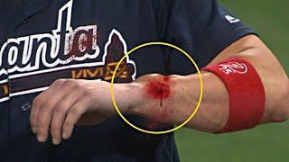 MLB•| Worst And Brutal Hit By Pitch