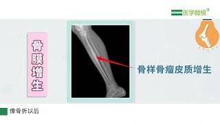 骨膜增生是怎么回事？影像学表现上有什么特点？