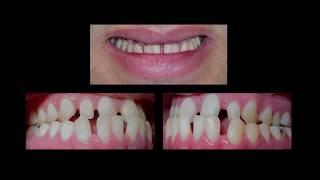 Invisalign and Dental Veneers to One Patient at Cosmetic Dental Associates