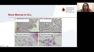 New frontiers and emerging treatments for CLL