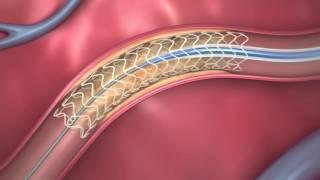 FDA-Approved Dissolving Heart Stent | How It Works