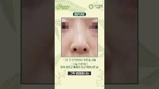 코 실 부작용 '비침' 쁘띠 닥터 해결 사례 🩺