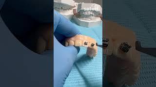 Фиксация брекетов #braces #брекеты #стоматология