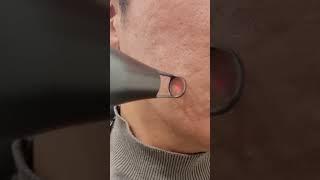 박피성 어븀야그 프락셀. 모공흉터 치료레이저