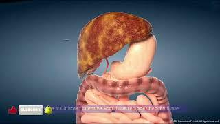 Fatty Liver Disease| Types |Stages | and Prevention Tips|