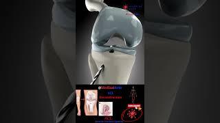 ACL Rupture  Reconstruction ∞ Medical Arts  Surgical 3D Animation