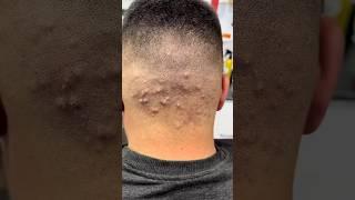 How to get rid of Hair Acne problem?#hair #mrbarber #beatiful #acne #viralvideo #viralshorts