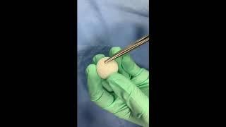 Suturing a Su-Por Implant