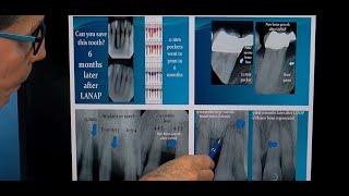 Dr. Tom McCawley - A Periodontal Case Study