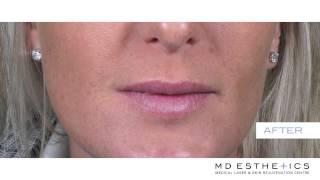 MD Esthetics Lips | Vancouver Video Production | Citrus Pie Media Group