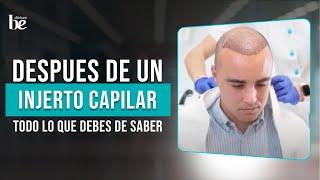 PRIMER LAVADO Post Injerto Capilar (96 horas después) | Clínicas Be 