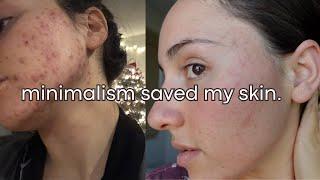 How decluttering my skincare saved my skin | Healing cystic acne naturally.