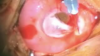 Hot corneoscleral graft. Dr AHMED Tawfik