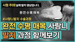 (시청주의/수술영상) 완전 수평 매복 사랑니 발치 과정 함께 보기!