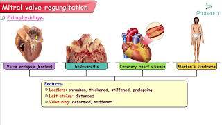 Mitral Regurgitation : Etiology, Pathophysiology, Clinical findings, Diagnosis and Treatment : USMLE