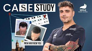 Case Study: 3900 Grafts Transformation with Dr. Gökay Bilgin | 12-Month Results at Smile Hair Clinic