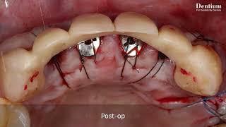 Dentium Bright Implant